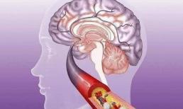 Khi 'nhồi máu não' đến, cơ thể sẽ phát ra 3 tín hiệu 'kêu cứu' này, bạn đừng phớt lờ 