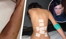 'Cô gái có khuôn mặt đẹp nhất thế giới' Bella Hadid gây lo lắng khi chia sẻ ảnh chân bầm tím và lưng dán đầy băng