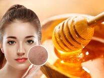 5 mẹo “đá bay” mụn trứng cá dậy thì rẻ mà lành tính