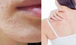 Nên và không nên làm gì khi da khô, bong tróc vào mùa lạnh?