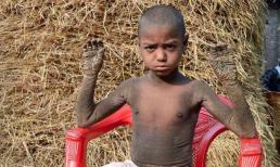 Cậu bé mắc bệnh lạ, cả người sắp 'hóa đá'