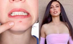 MC Huyền Ny bật mí 5 mẹo, chị em nên nhớ khi bị nổi mụn để nhanh chóng 'xẹp'