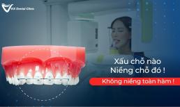 Khắc phục răng cửa xấu với niềng răng cửa chọn lọc chỉ từ 3 tháng