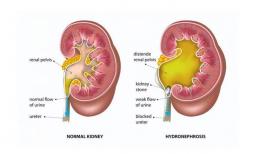 Muốn tránh xa chứng nhiễm độc niệu, có phải bắt đầu thay đổi “sớm” 4 thói quen hàng ngày