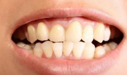 5 nguyên nhân tụt nướu, khắc phục ngay, về già vẫn có hàm răng đều đẹp 