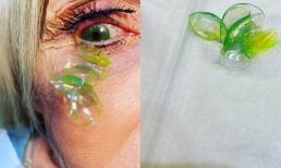 Một bà lão quên tháo kính áp tròng trước khi đi ngủ, cho đến khi tích lũy bên trong 23 mắt