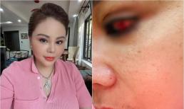 Lê Giang bất ngờ thông báo bị rách giác mạc, tình trạng hiện tại gây lo lắng