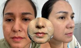 Sản phẩm Peel da nào tốt và an toàn hiện nay?