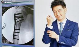 Lâm Chí Dĩnh khiến fan xót xa khi đăng ảnh chấn thương phải đóng 10 chiếc đinh lớn vào tay sau tai nạn ô tô