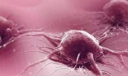 Nếu bạn mắc phải loại ung thư này, đừng lo lắng, về cơ bản các bác sĩ có thể chữa khỏi và bạn có thể hưởng lợi từ việc điều trị sớm!