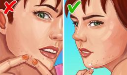 6 cách ngăn ngừa mụn