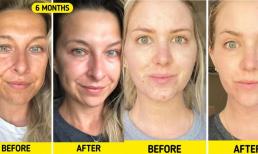 Làm thế nào để giảm nếp nhăn quanh mặt, cổ hoặc ngực của bạn