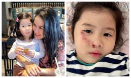 Con gái Thân Thúy Hà bị té khiến dung mạo trầy trụa khá nặng