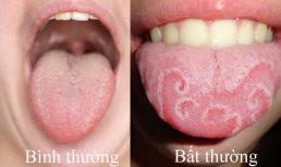 Lưỡi có đốm trắng là gì và phải làm sao để khắc phục?