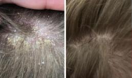 Nguyên nhân gây ra gàu và cách điều trị