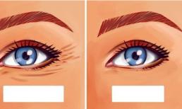 Cách giảm vết chân chim ở mắt