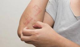 Nhắc nhở: Hai bộ phận trên cơ thể bị “ngứa ngáy”, đừng lầm tưởng là dị ứng, là dấu hiệu của ung thư gan, cần hết sức cảnh giác