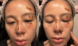 Đăng ảnh mặt đầy vết thương, Nam Thư bất ngờ tiết lộ từng bị tai nạn dịp cận Tết