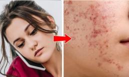 Thói quen nào khiến 8 vùng cơ thể này nổi mụn?