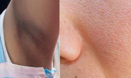 Vùng nách thâm, lỗ chân lông to làm sao để loại bỏ mà không cần đến thẩm mỹ viện?