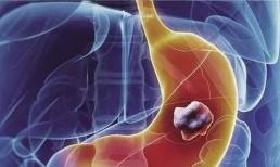 Ung thư dạ dày khủng khiếp như vậy, làm thế nào để phòng ngừa ung thư dạ dày? 