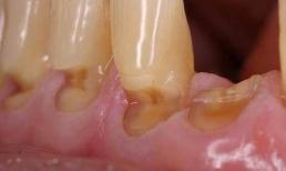 Một khi nướu co lại, rất dễ hở răng và chân răng bị đau, phương pháp này có thể giúp bạn rất trực tiếp​