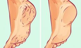 Tại sao gót chân bị nứt và cách khắc phục tự nhiên