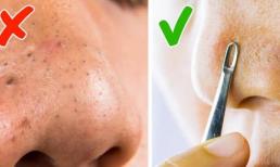 8 cách trị mụn và giúp da hết sẹo