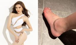 Thanh Thanh Huyền diện bikini khoe body 'khét lẹt', gây xót xa với đôi chân sưng húp