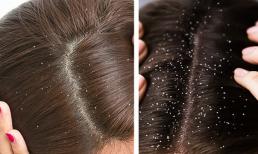 5 điều sẽ khiến bạn bị gàu và làm thế nào để thoát khỏi nó?