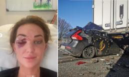 Hoa hậu Hoàn vũ Bỉ 2022 - Chayenne Van Aarle lộ gương mặt biến dạng sau vụ tai nạn xe nghiêm trọng