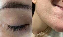 Làm thế nào để điều trị những nốt mụn sữa trắng liên tục xuất hiện trên khuôn mặt của bạn