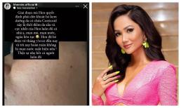 H'Hen Niê gây choáng khi công khai làn da chi chít mụn vì xài kem trộn suốt 9 năm