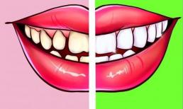 Bọc răng sứ là gì