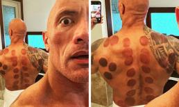 Liệu pháp chữa bệnh cổ xưa - giác hơi được 8 người nổi tiếng này dùng, bác sĩ nói gì?