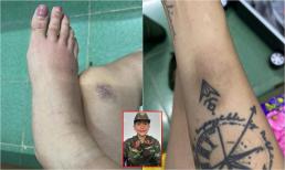 Võ Hoàng Yến bị thoái hóa khớp gối, tràn dịch mắt cá chân khi tham gia show thực tế 