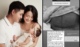 Karen Nguyễn hé lộ hình ảnh vết mổ gây ám ảnh, chia sẻ trải nghiệm của mình khi sinh mổ
