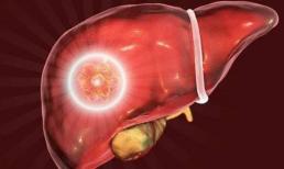 Có 4 dấu hiệu ở tay chân, gan đã 'thối', cẩn thận bệnh gan đang 'cầu cứu' bạn