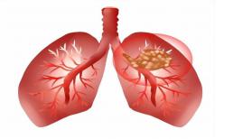 Làm thế nào để xua tan các nốt phổi được phát hiện? Bác sĩ: Nếu thường xuyên ăn 3 loại trái cây này, nốt sùi có thể “tự khỏi”