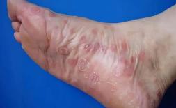 Bệnh giang mai thích chơi trò 'tiềm ẩn', nếu cơ thể có 5 thay đổi này thì nên đến bệnh viện khám