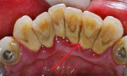Làm thế nào để loại bỏ vôi răng? Nếu áp dụng đúng phương pháp này, bạn có thể dễ dàng loại bỏ vôi răng cứng đầu ngay tại nhà!