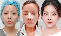 Cô gái 9x đi phẫu thuật toàn bộ gương mặt, ngỡ ngàng nhan sắc sau khi dao kéo