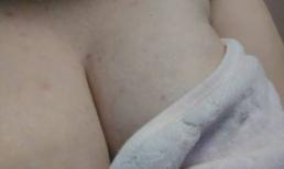 Bị mụn ở ngực phải làm sao, nguyên nhân gây mụn ở ngực 