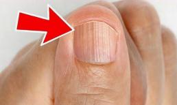 Bất kể nam hay nữ, nếu móng tay có “đường thẳng đứng” là 3 “bệnh” bước vào cửa, tự khám càng sớm càng tốt