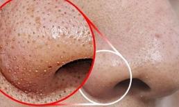 Chất trắng tiết ra khi bạn nặn mụn trên mũi là gì? Làm thế nào để loại bỏ chúng?