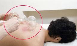 Trong lúc giác hơi, vết thâm hút ra từ lưng có thực sự là độc tố? Bác sĩ đã nói với bạn sự thật