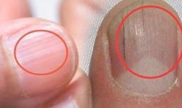 Bất kể nam hay nữ, nếu móng tay có 'đường thẳng đứng' là 3 'bệnh' bước vào cửa, tự khám càng sớm càng tốt