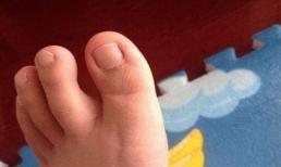 Mỡ máu có cao hay không thì nhìn bắp chân là có thể hiểu được? Có 4 triệu chứng này chứng tỏ mỡ máu cao