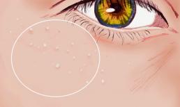 Mụn trắng xuất hiện gần mắt là gì và tại sao bạn không nên tự loại bỏ chúng