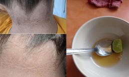 4 biện pháp khắc phục tại nhà để làm mờ vết thâm trên da mà không tốn nhiều tiền